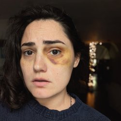 Ashtyn Demoralizer, sporting a black eye, furrows eyebrows and looks into camera. Navy blue knit sweater with small silver chain peaking out under neckline. Background has decorative lights around a pillar inside. Warmly tones.